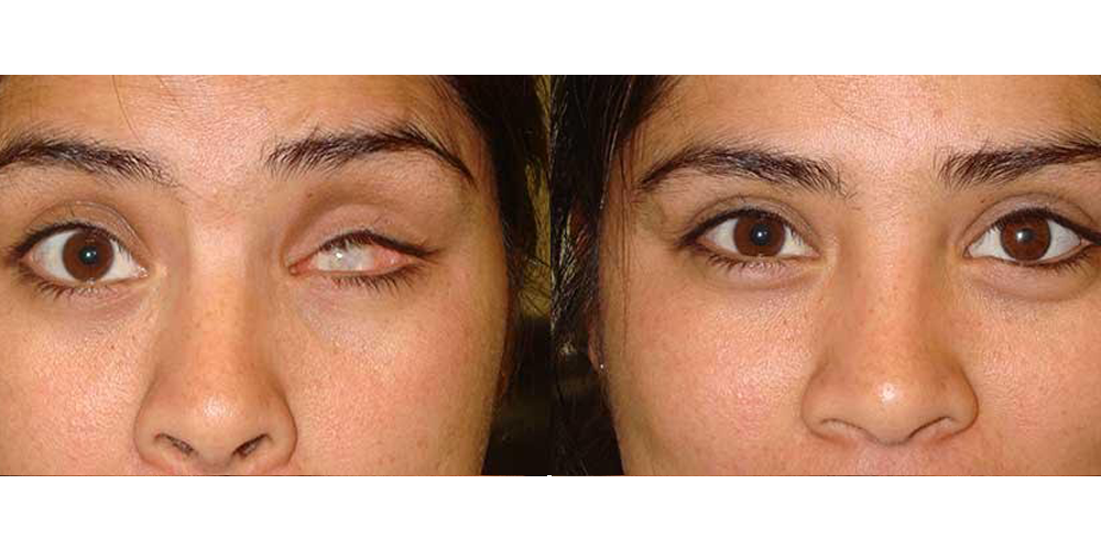 Ocular Prosthetics – Advanced Prosthetics and Orthotics
